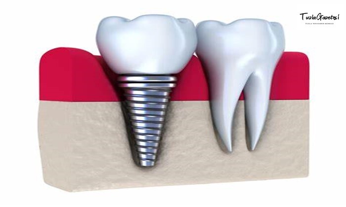 Lazer Destekli implant Nedir?