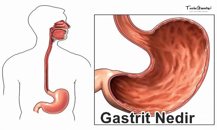 Gastrit Nedir