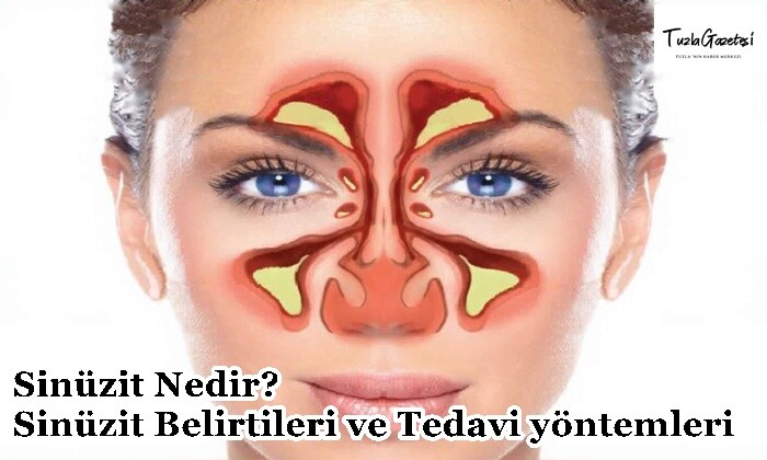 Sinüzit Nedir Sinüzit Belirtileri ve Tedavi yöntemleri