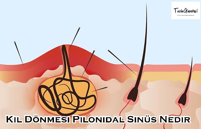 Kıl Dönmesi Pilonidal Sinüs Nedir