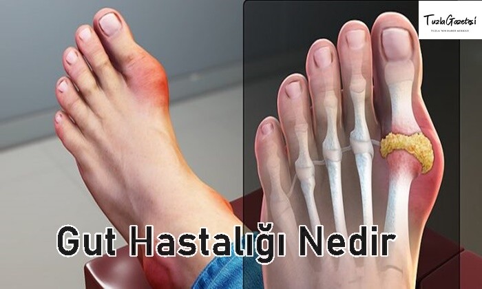 Gut Hastalığı Nedir