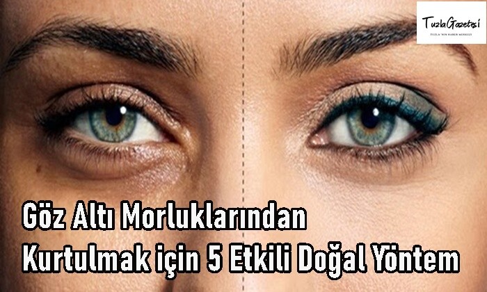 Göz Altı Morluklarından Kurtulmak için 5 Etkili Doğal Yöntem