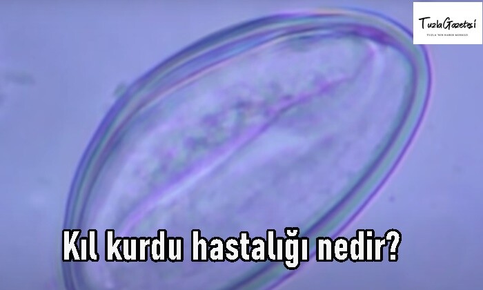 Kıl kurdu hastalığı nedir