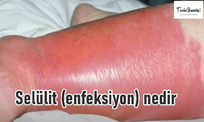 Selülit (enfeksiyon) nedir