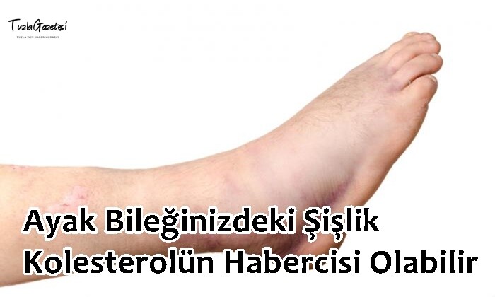 Ayak Bileğinizdeki Şişlik Kolesterolün Habercisi Olabilir