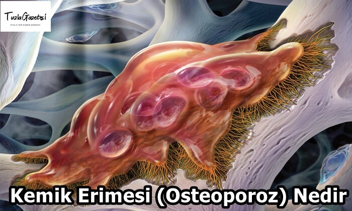 Kemik Erimesi (Osteoporoz) Nedir?