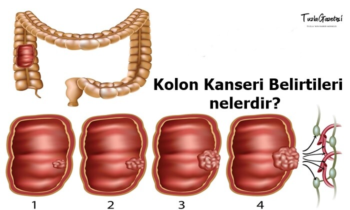 Kolon Kanseri Belirtileri nedir