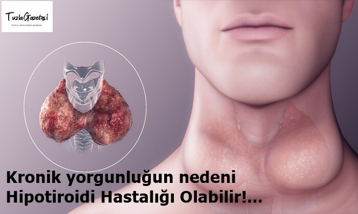 Kronik yorgunluğun nedeni Hipotiroidi Hastalığı Olabilir