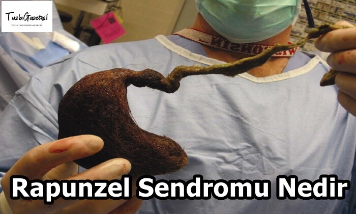 Rapunzel Sendromu Nedir