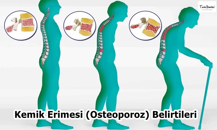 Kemik Erimesi Osteoporoz Belirtileri