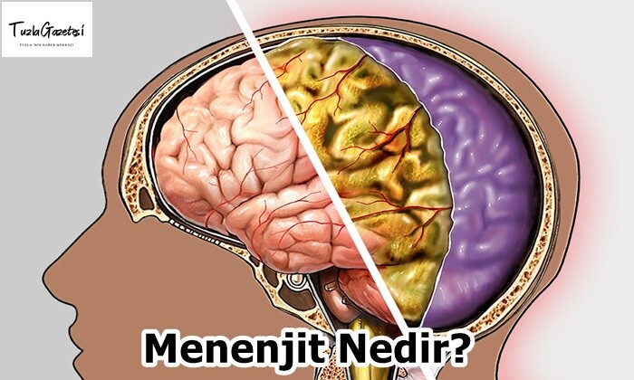 Menenjit Nedir?