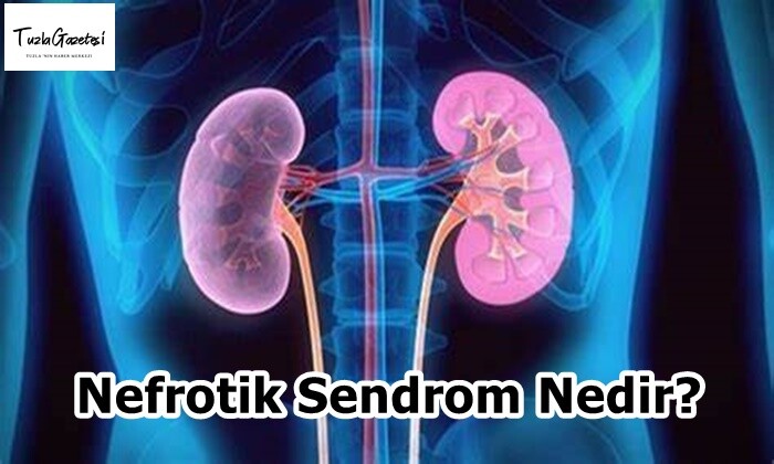 Nefrotik Sendrom Nedir