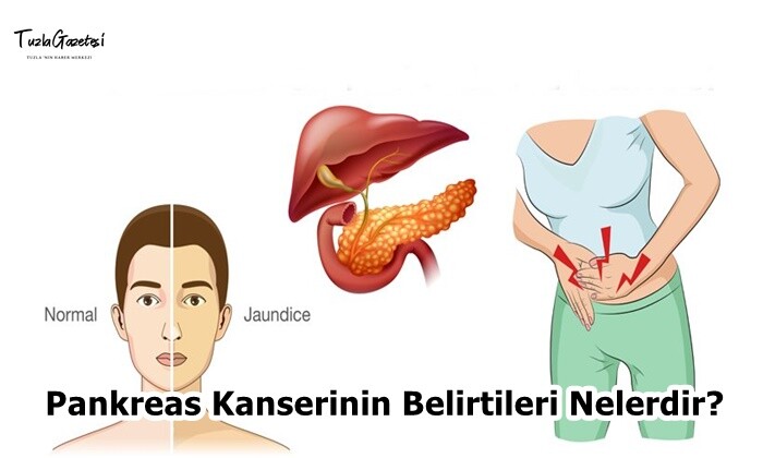 Pankreas Kanserinin Belirtileri Nelerdir?