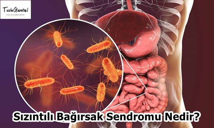 Sızıntılı Bağırsak Sendromu Nedir