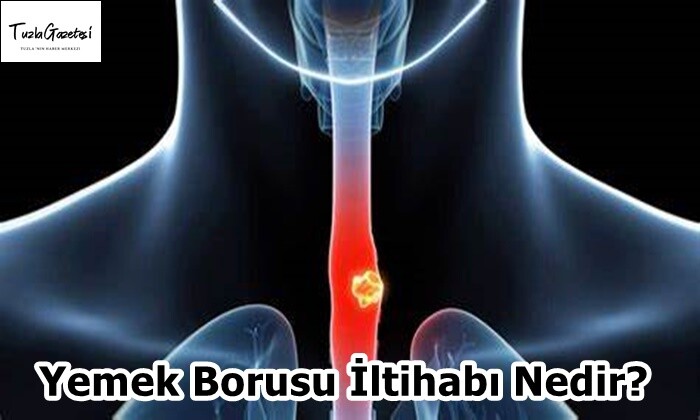 Yemek Borusu İltihabı Nedir