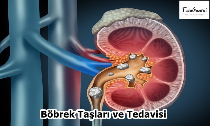 Böbrek Taşları ve Tedavisi