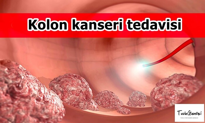 Kolon kanseri tedavisi