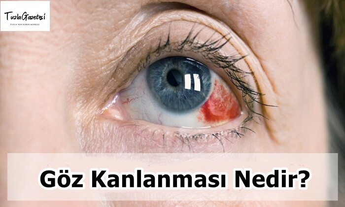 Göz Kanlanması Nedir?